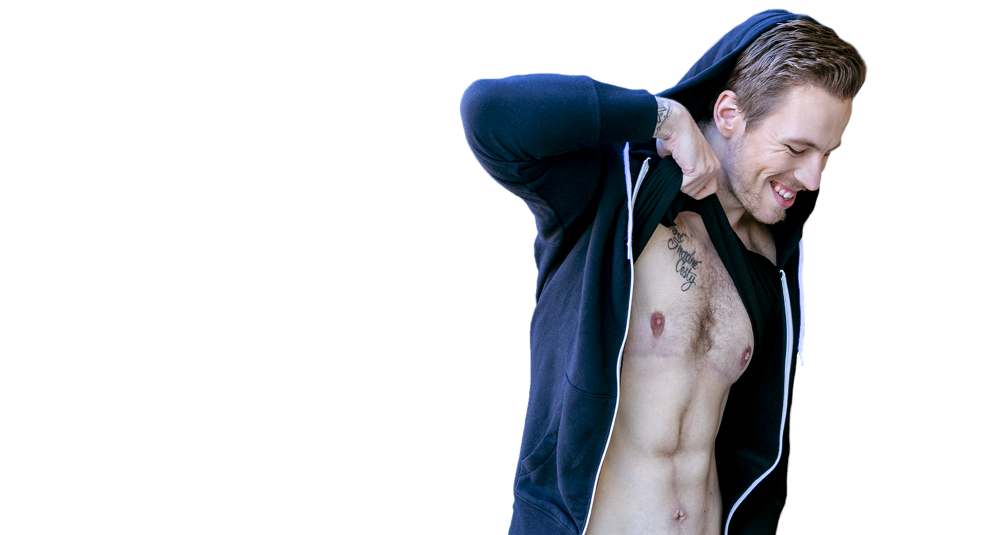 Mr David 27 - Abdominoplasty + gynecomastia